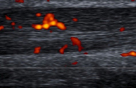 Doppler image of Achilles tendon - grade III vascularization